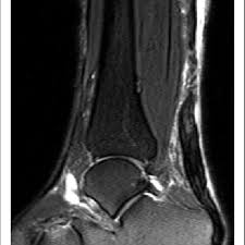 We did not find results for: Total Achilles Tendon Rupture About 9 Cm Proximal To The Calcanean Download Scientific Diagram