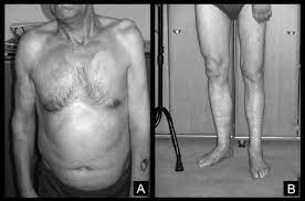 Build muscle at any age with these muscle building and strength training tips and feel younger and energetic again. Unilateral Progressive Muscular Atrophy With Fast Symptoms Progression Sciencedirect