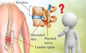 Some slipped disks don't cause any symptoms, whereas others lead to severe back pain. Slipped Disc Facts Symptoms Treatments Top 10 Top Ten Gama