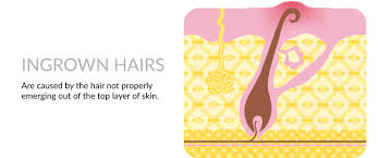 An ingrown hair is a hair that grows into the skin rather than out and is most common in the bikini if you're in need of help fast, reach for an ingrown hair fighter, but make sure to keep it on the outside. Why Ingrown Hairs Are Bad For Your Skin And How Viabuff Can Help Viabuff