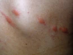 Breast skin that looks and feels thick and pitted. The Differential Diagnosis Of Itchy Skin Dermnet Nz