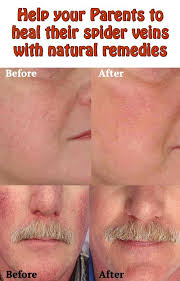 Help Your Parents To Heal Their Spider Veins With Natural Remedies In 2020 Spider Veins Varicose Vein Remedy Natural Remedies