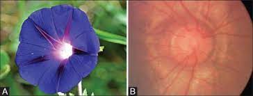 Morning Glory Syndrome With Moyamoya Disease A Rare Association With Role Of Imaging Abstract Europe Pmc