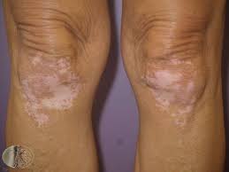 • follicular thyroid cancer (ftc): Skin Signs Of Thyroid Disease Hypothyroid Mom