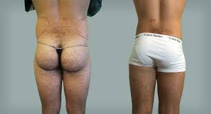 Liposuzione Fianchi L 039 Intervento Di Lipolaser Ai Fianchi