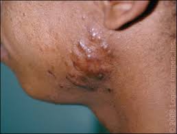 Take some lemon juice based on the size of your scar and apply it on the affected area using a you can get rid of those pesky shaving scars by following these home remedies or by consulting a dermatologist. Management Of Keloids And Hypertrophic Scars American Family Physician
