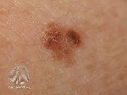 Basal cell carcinoma (bcc) symptoms are more likely to develop on skin that is regularly exposed to the sun, especially on the face, head and neck. Skin Cancer Image Gallery Pictures And Photos