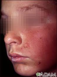Spanish Hie Multimedia Dermatitis Contacto En La Mejilla