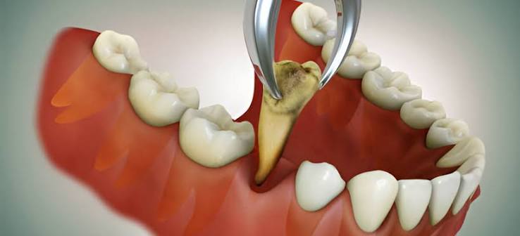 Emergency tooth extraction New Brunswick