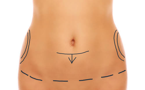 Abdominoplastie - Lifting du ventre à Paris - Dr Hunsinger