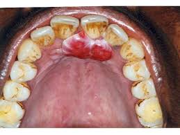 Image result for granuloma gum disease
