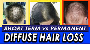 Hair loss in man and in women is a distressing condition. Permanent Vs Temporary Diffuse Hair Loss And Telogen Effluvium How To Differentiate Youtube