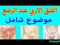 الفتق الاربي عند الرضع الموسوعة