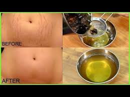 Youtube Oil For Stretch Marks Stretch Mark Removal Stretch Marks
