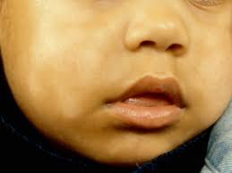 We did not find results for: Pityriasis Alba Patientenfolder