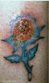 If you're experiencing an infection, treatment depends on the cause. Infected Tattoo In A Patient With Diabetes Patient Care Online