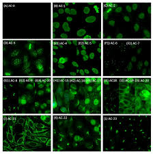 Image result for ANA Staining Pattern