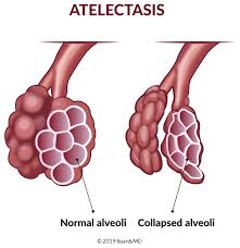 Image result for Postpartum Fever