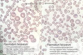 Malaria is a disease that spreads via the bite of an infected mosquito. Plasmodium Falciparum Blood Smear Key Features Suggesting Grepmed