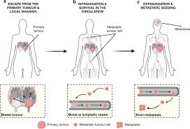 How will you know if your breast cancer has spread? The Lingering Mysteries Of Metastatic Recurrence In Breast Cancer British Journal Of Cancer