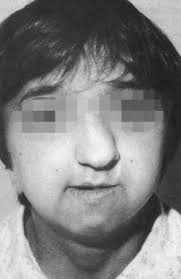Crouzon Syndrome Clinical Presentation: History, Physical Examination,  Complications