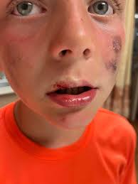 Prayer for child's lip injury after baseball accident