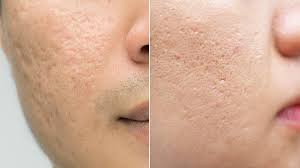 Acne can be a painful and embarrassing skin condition, and the scars it leaves behind are an unwelcome reminder of that. Acne Scars How To Remove Them And Regain Your Confidence Everyday Health