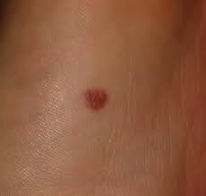 When skin cancer is found early, it can be treated more easily. Had This On The Bottom Of My Foot For A While And Not Had Any Issues But Should I Be Concerned Skincancer