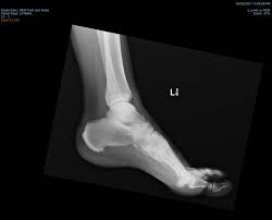 File Calcification In Achilles Tendon Insertion And Calcaneal Spur Png Wikimedia Commons