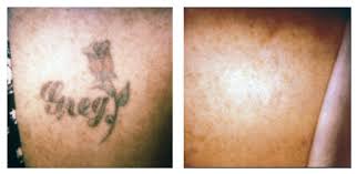 Maybe you would like to learn more about one of these? Laser Tattoo Removal Orlando Dermatology Center