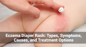 Image result for diaper dermatitis