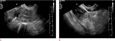 Culdocentesis Information | Mount Sinai - New York