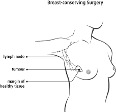 Male Breast Reduction Before & After Photo Gallery | Tps