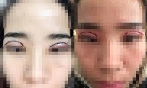 Bi hài hậu vận thẩm mỹ: Tin quảng cáo "mí đẹp tự nhiên sau 60 phút", cô gái  gặp biến chứng, đang ngủ mắt vẫn "mở trừng trừng"