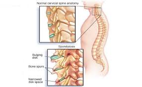 Pin On Thoracic Spondylosis