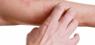A psoríase é uma doença inflamatória crônica de pele que provoca sintomas característicos como manchas vermelhas e ressecadas, que podem causar sensação de coceira, ligeira queimação ou dor. Psoriase Saiba O Que E E Como Tratar A Doenca Inflamatoria Da Pele Portal Lago Sul