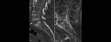 Mrt bilder lws entzündung ein mrt der lendenwirbelsäule, also eine magnetresonanztomographie, dient der bildgebung zur untersuchung und hilft bei der diagnosestellung. Warum Ein Mrt Klinische Urteilsfahigkeit Nicht Ersetzen Kann Swiss Medical Forum