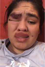 MIREN COMO TENGO MI CARA😭😰🥺#megolpee #lastimadura #hazmeviral #para...