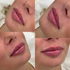 So… for my gorgeous client it was about creating volume and crisp borders.  Beautiful results 👄😊 #vermillionborder #cupidsbowlift #lipstolove  #lipfillerwigan #fillerswigan #aestheticsclinic #bellaaestheticswigan
