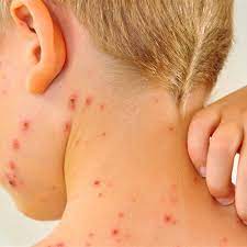 Safety of varicella vaccine after licensure in the united states: Chickenpox Varicella Vaccine What You Need To Know Healthychildren Org