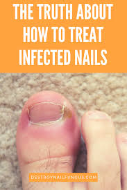 It Is Surprisingly Easy To Get An Infection Of Your Nails Or An Infection Of The Skin Around You Home Treatment Toenail Fungus Treatment Nail Fungus Treatment