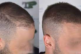 Effetto ricostruttivo o di infoltimento pre/post autotrapianto di capelli . Tricopigmentazione Effetto Densita Il Camouflage Per Capelli Lunghi