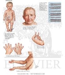Signs and symptoms may vary among affected individuals. Metaphyseal Chondrodysplasias