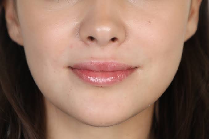 Get Luxurious Natural Fillers in Dubai | Get Lip Fillers Today