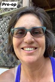 Breast implant removal experience