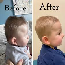 Helmet Therapy Flat Head Syndrome هل يمكن تقليل مدة العلاج بخوذة تصحيح شكل الرأس؟