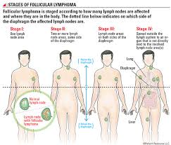 Treatment, stages, prognosis, and more. Patient Resource Publishing Follicular Lymphoma Staging
