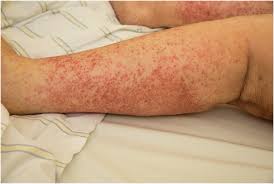 Rocky mountain spotted fever epidemiology. The Rash That Becomes Purpuric Petechial Hemorrhagic Or Ecchymotic Sciencedirect
