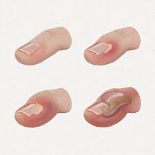 Image result for paronychium