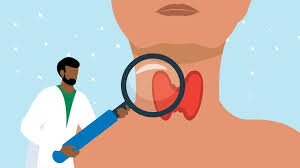 Image result for Hyperthyroidism